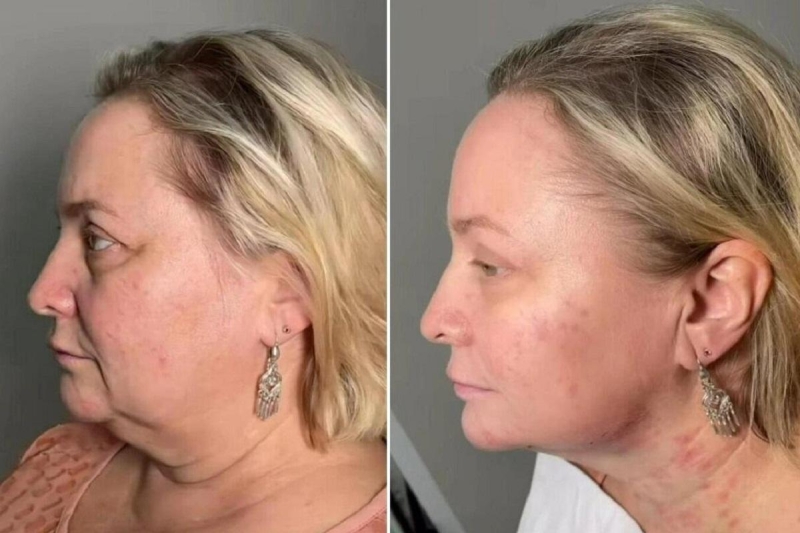 Получилось натурально: Светлана Пермякова показала результат пластической операции